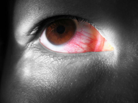 konjuktivitis