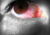 konjuktivitis