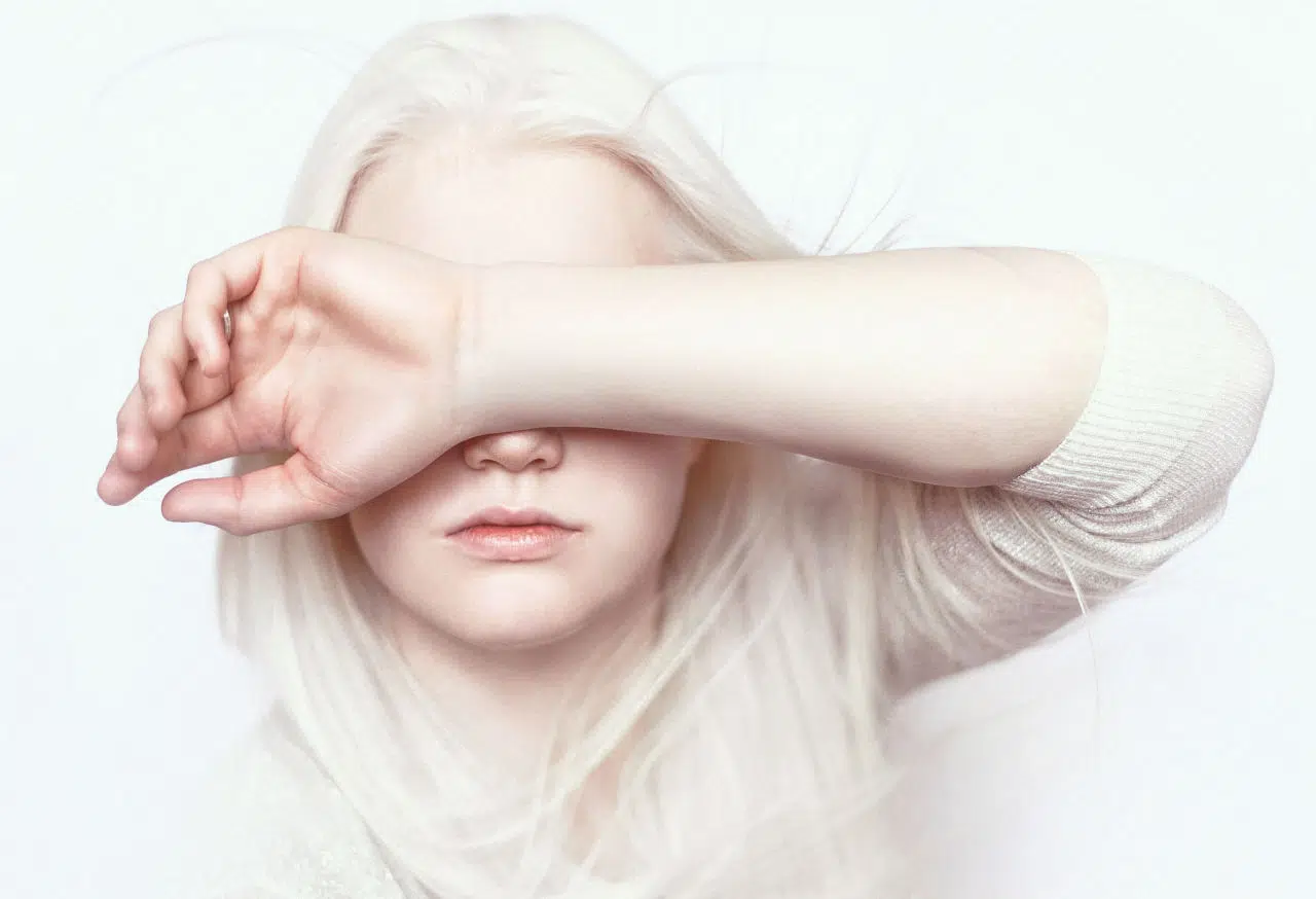 albinizam oka, ocni albinizam, albinizam oci, albino oči, albinizam vid