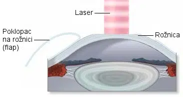 Excimer laser, laserska korekcija vida