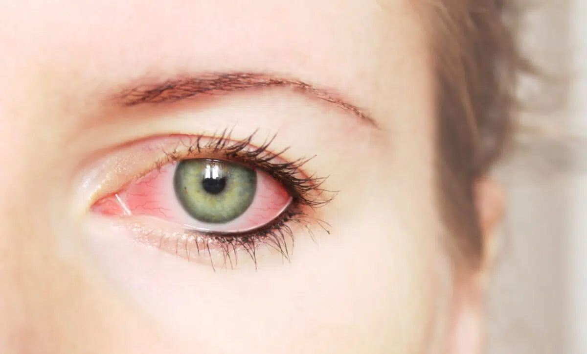konjkutivitis prevencija, crveno oko prevencija