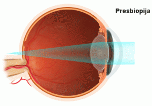 presbiopija, staračka dalekovidnost, prezbiopija oka