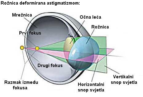 astigmatizam oka