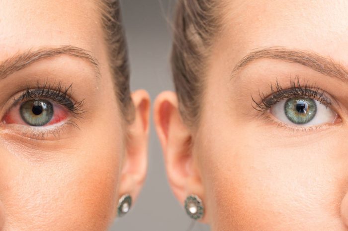 Crveno oko: Simptomi i prevencija