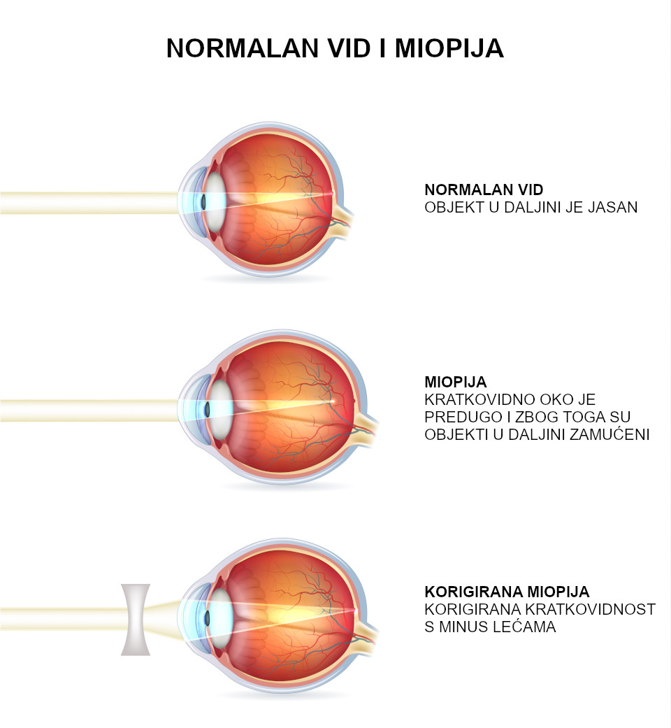 Normalan vid i miopija