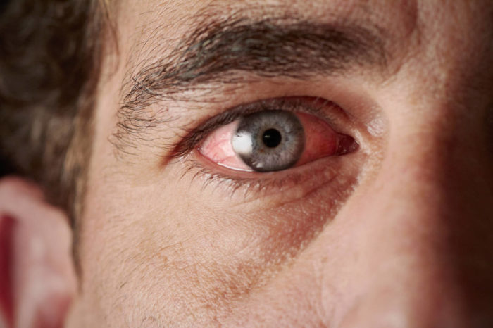Ozljeda oka – 5 najčešćih ozljeda i kada nazvati hitnu pomoć