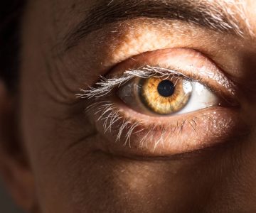 Natečeni kapci – 8 najčešćih uzroka otečenih kapaka
