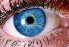 Ablacija retine, ablacija mrežnice, odvajanje mrežnice