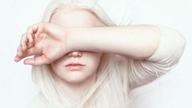 albinizam oka, ocni albinizam, albinizam oci, albino oči, albinizam vid