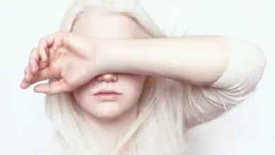 albinizam oka, ocni albinizam, albinizam oci, albino oči, albinizam vid