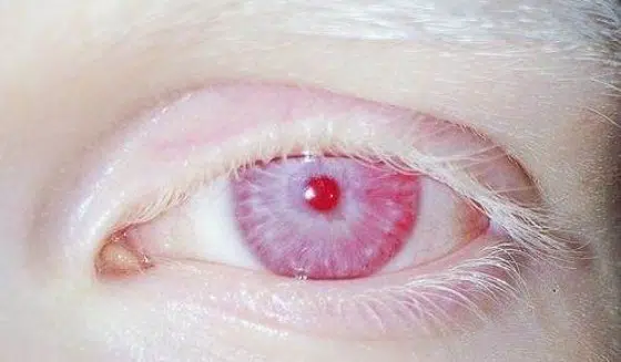 Albino crvene oči