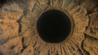 aniridija, nedostatak šarenice