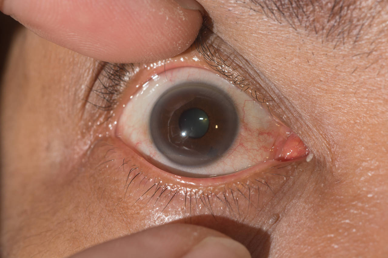 bijeli prsten na roznici oka, arcus senilis, visoki kolesterol