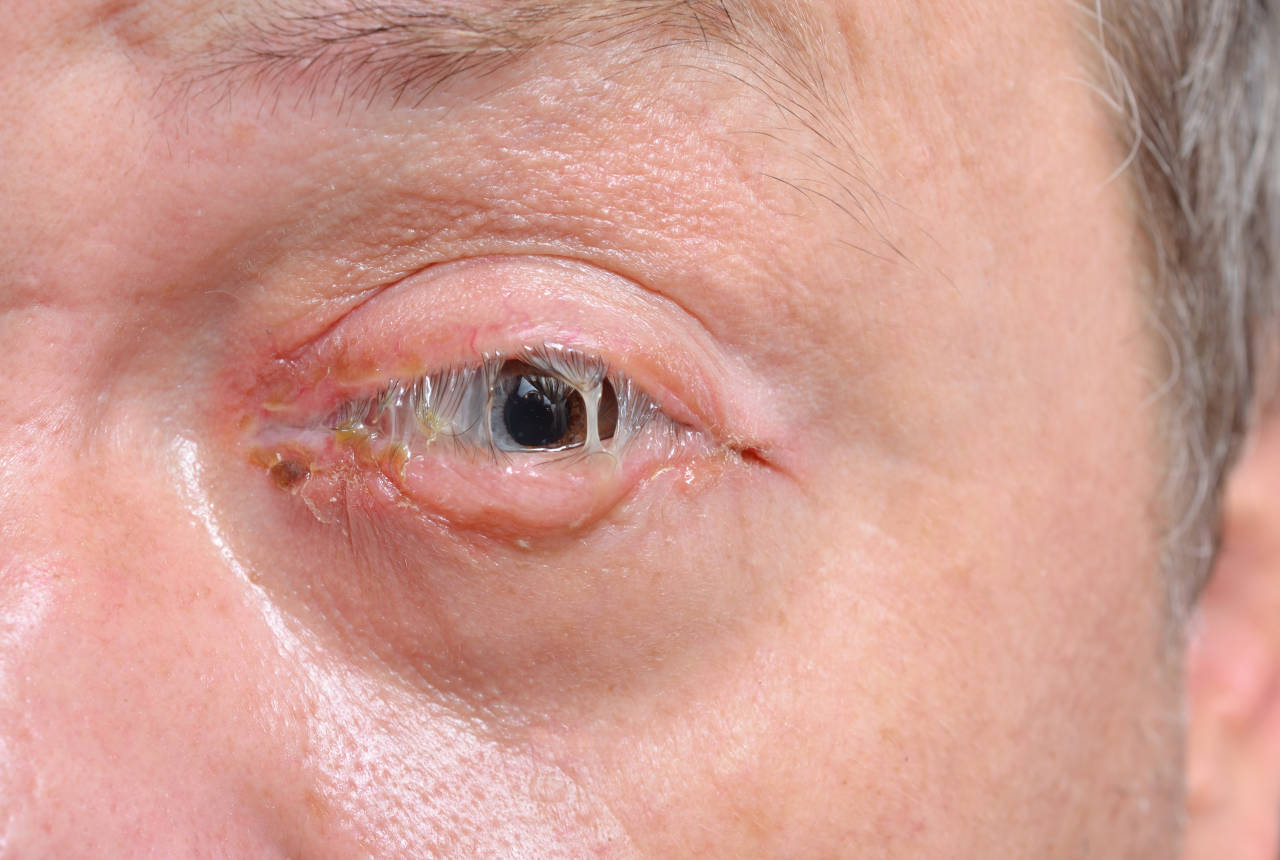Bakterijska upala oka s obilnim gnojnim iscjedkom