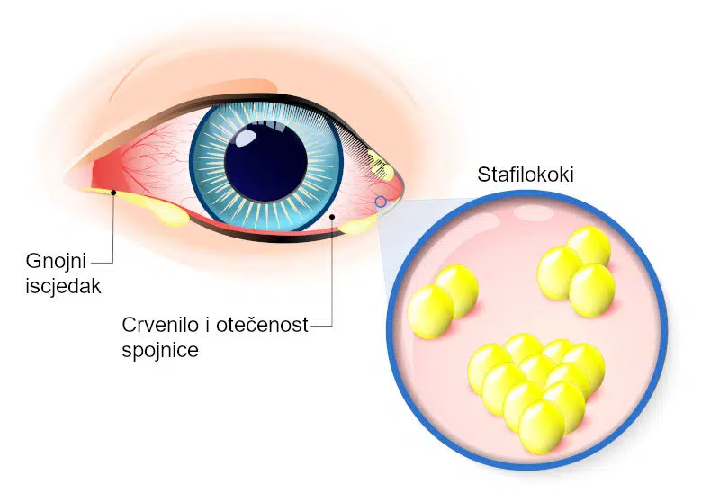 Bakterijski konjunktivitis simptomi infografika