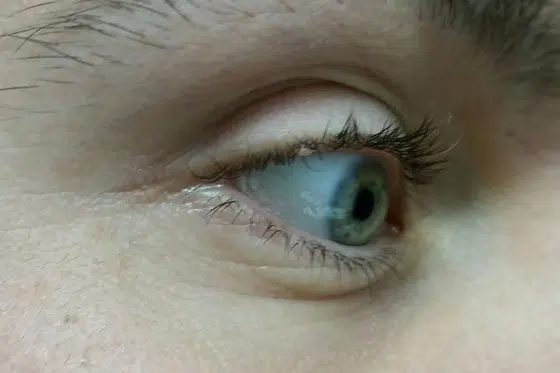 bradavica na kapku, bradavica na trepavici