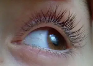 bubuljica na bjeloočnici