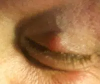 chalazion, izraslina na kapku