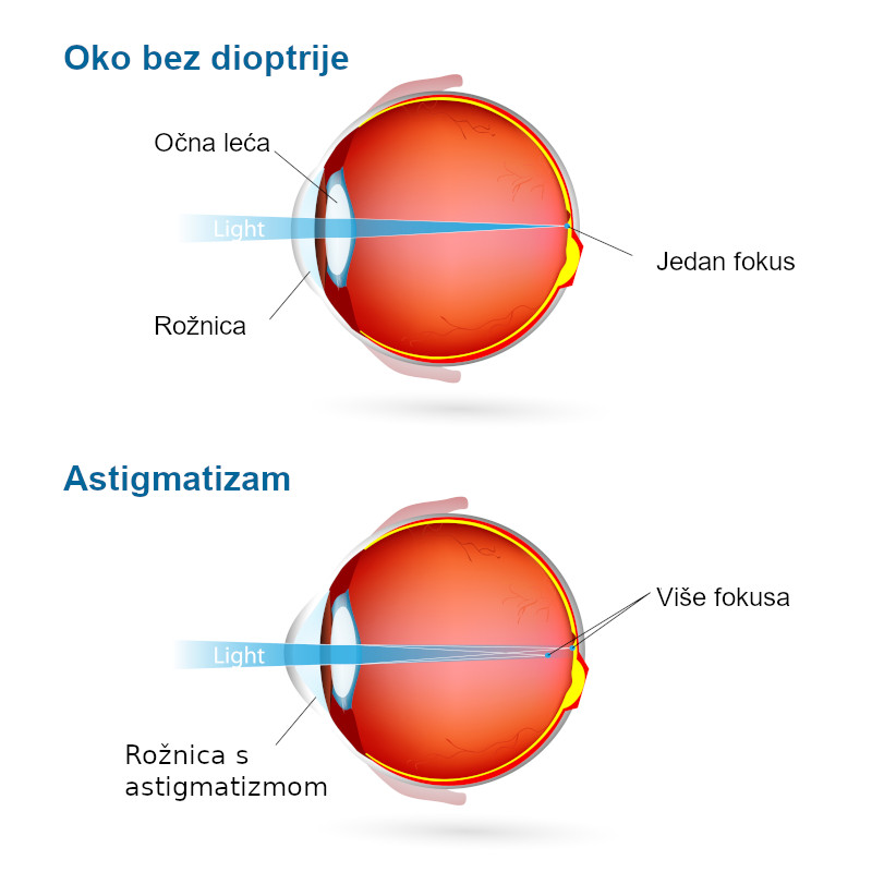 Cilindar na oku infografika