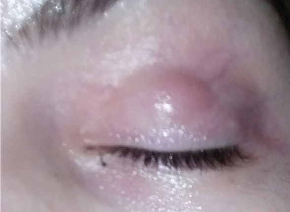 crvenilo očnih kapaka