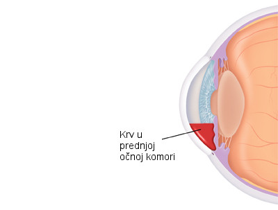 krvarenje unutar oka