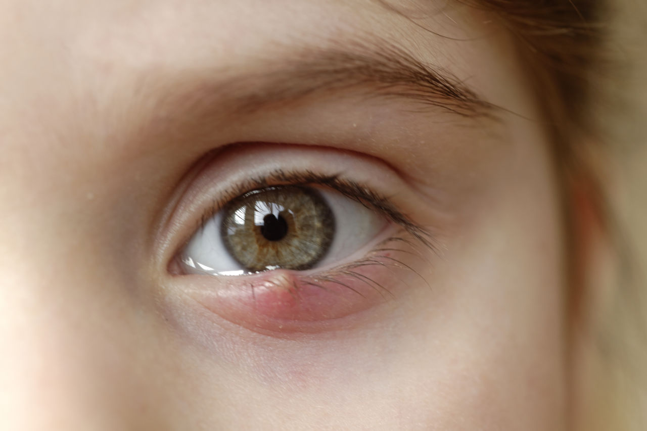 Što je ječmenac i kako se liječi? | Optometrija.net