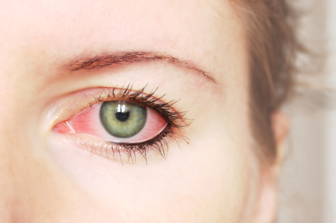 konjkutivitis prevencija, crveno oko prevencija