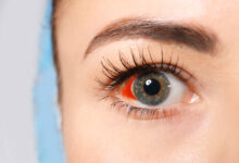 krv u oku, pucanje kapilara u oku, puknuta kapilara u oku