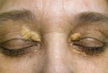 ksantelazma, masne nakupine oko očiju, masno tkivo na oku