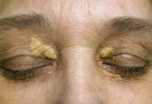ksantelazma, masne nakupine oko očiju, masno tkivo na oku