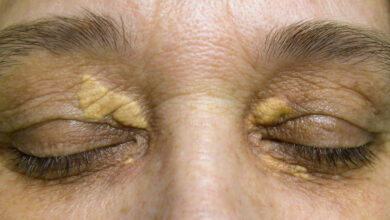 ksantelazma, masne nakupine oko očiju, masno tkivo na oku