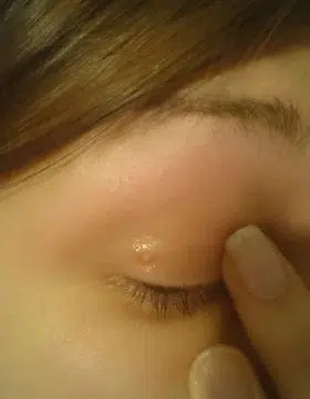 kvržica na kapku, prišt na kapku