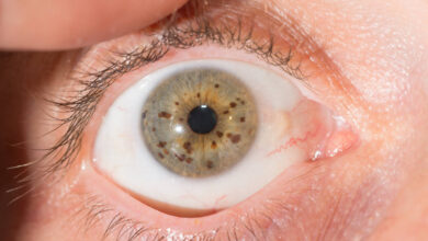 madež u oku, nevus oka