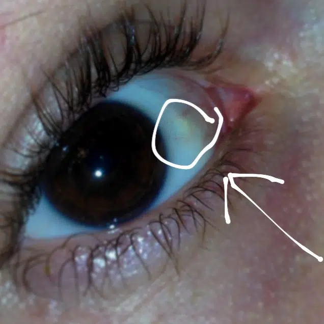 Mrlja na bjeloočnici