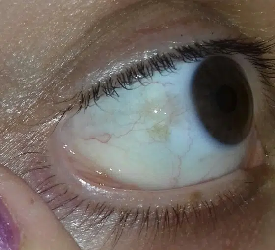 Mrljica na bjeloočnici oka