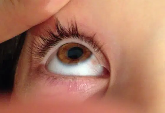 nevus na bjeloočnici