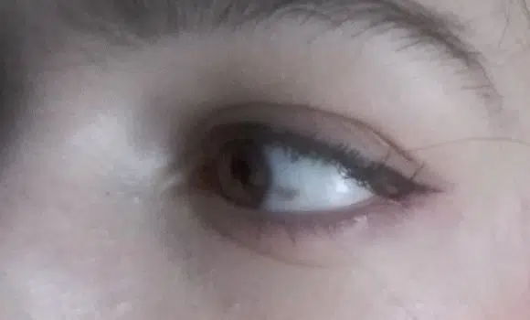 Pigmentacija na oku kirurško uklanjanje