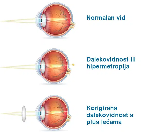 plus dioptrija, dalekovidnost