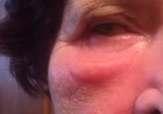 podočnjak s kesicom