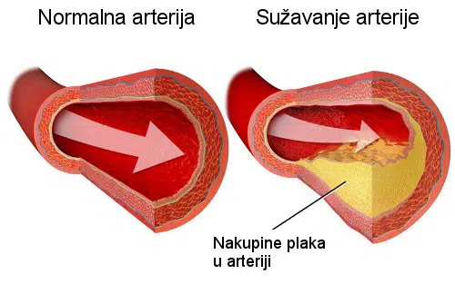 povišeni kolesterol, utjecaj kolesterola na vid