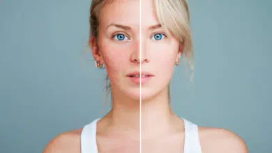 rosacea oka, očna rosacea, rosacea očiju, rosacea oko očiju