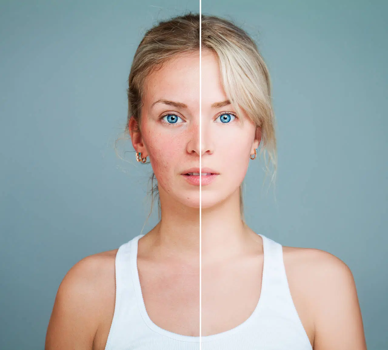 rosacea oka, očna rosacea, rosacea očiju, rosacea oko očiju
