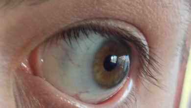 sivkasta mrlja na bjeloočnici