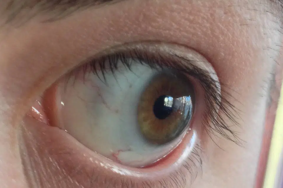 sivkasta mrlja na bjeloočnici