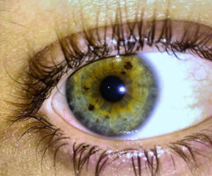 Smeđe mrlje na šarenici oka