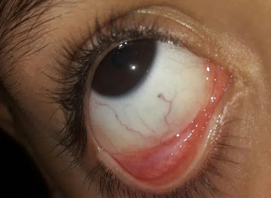 Tockica na vrhu krvne zile u oku