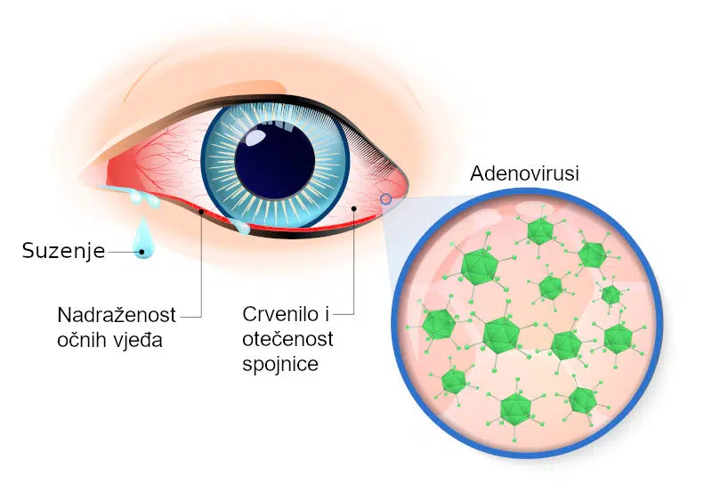 Virusni konjunktivitis simptomi infografika