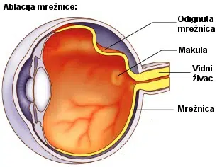 ablacija mreznice, mrežnice, ablacija