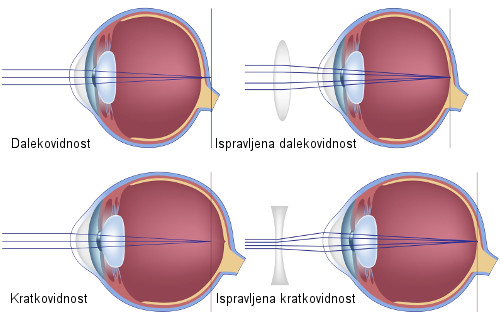 dalekovidnost i kratkovidnost