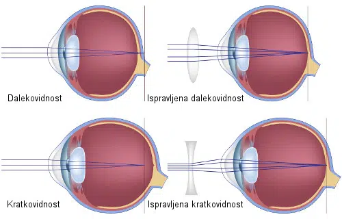 dalekovidnost i kratkovidnost
